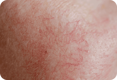 DermaV - LP 5 dermav 03