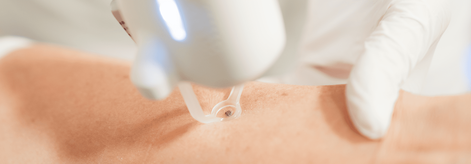Behandlung mit Laser in Hautarztpraxis Haut & Herzlich