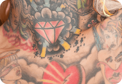 Tattooentfernung - LP 3 Tattoo vor der Entfernung