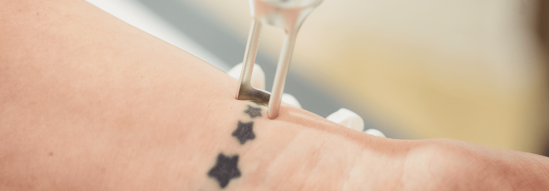 Tattooentfernung - LP 1 Laser Tattooentfernung Behandlung durch Dr. Elisabeth Stammler