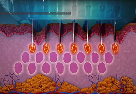 Microneedling 3 Grafische Darstellung von Wirkungsprinzip des RF Microneedling